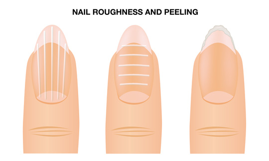 NAIL ROUGHNESS AND PEELING