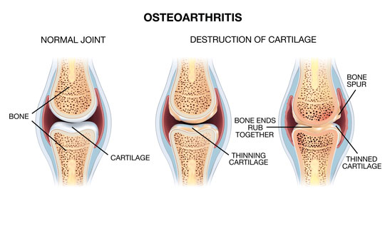 OSTEOARTHRITIS