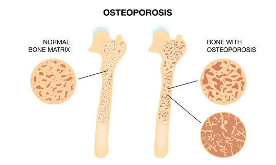 OSTEOPOROSIS