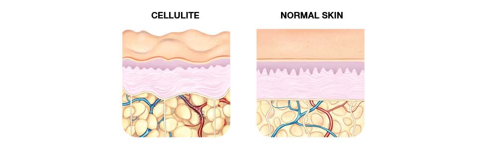 REDUCE CELLULITE CHART